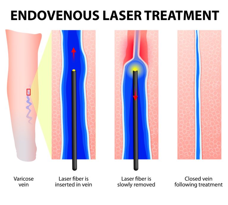 Varicose Veins – Westchester Vein Specialists